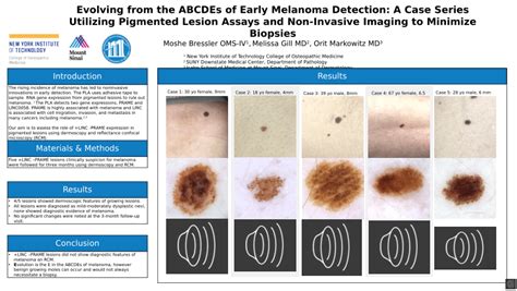 Pdf Evolving From The Abcdes Of Early Melanoma Detection A Case