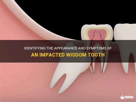 Identifying The Appearance And Symptoms Of An Impacted Wisdom Tooth