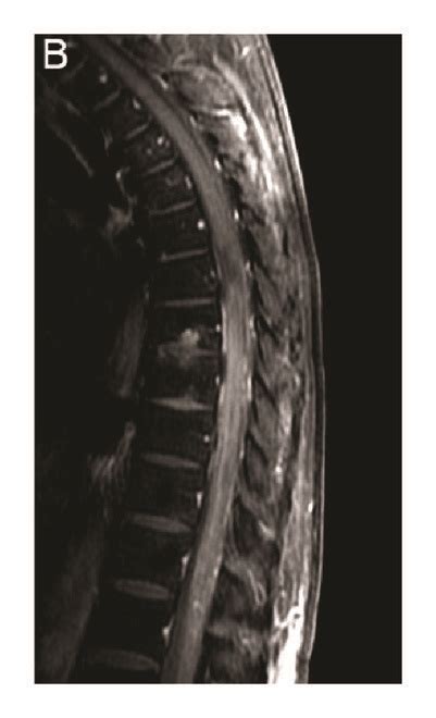 Spinal Cord Magnetic Resonance Imaging Sagittal T2 Weighted Mri Shows