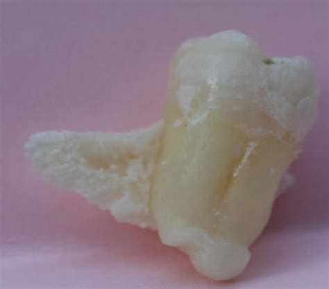 Lingual Plate Fracture