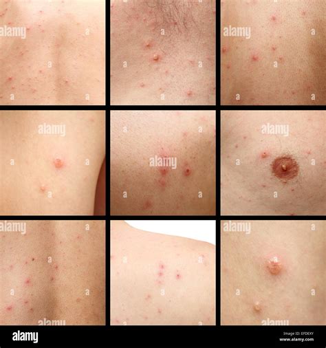 Vesicular Rash Hi Res Stock Photography And Images Alamy