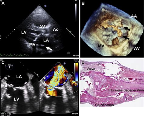 Multiple Cardiac Calcified Amorphous Tumors Jacc Case Reports