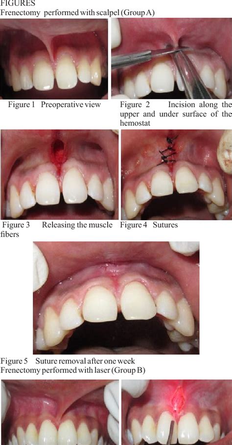 Comparative Evaluation Of Frenectomy Procedures Performed With Scalpel