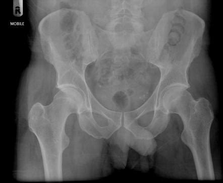 Top Photos In Normal Pelvis X Ray Hot Sex Picture