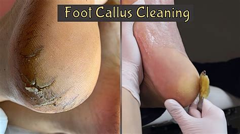 Callus Removal From Feet Foot Callus Removal Satisfying Youtube