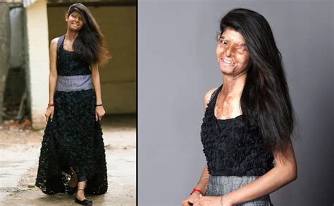 You Re Beautiful A Truly Inspiring Photo Shoot Of Acid Attack Victims Photos News Firstpost