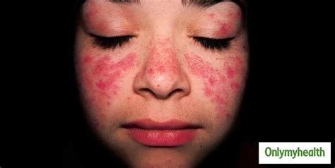 Systemic Lupus Erythematosus In Kids Understanding Sle And Its