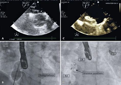 Patent Foramen Ovale Closure With Prosthesis For Occlusion Of Atrial