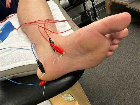 Does Dry Needling Help Plantar Fasciitis Back In The Game Pt