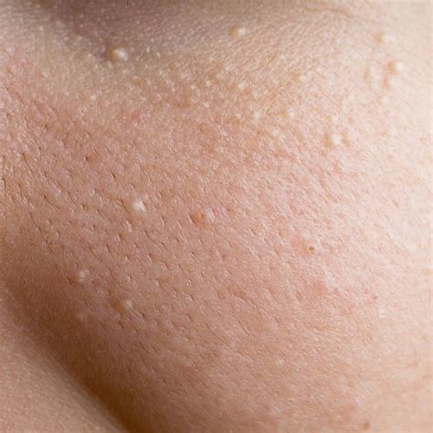 12 Bumps On Your Skin That Are Totally Normal—and You Shouldnt Pop