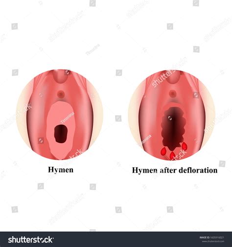 Structure Vulva Hymen Hymenoplasty Hymen After Stock Vector Royalty Free 1605916021 Shutterstock