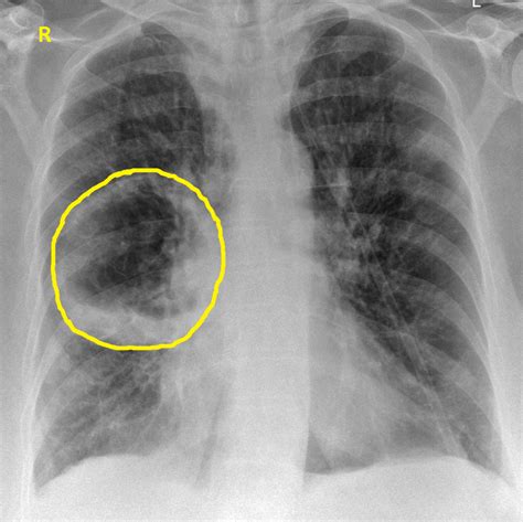 Lung Abscess Chest X Ray Wikidoc