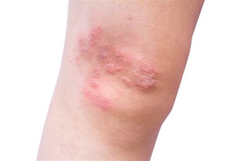 What Causes Dermatitis Herpetiformis Redorbit Dermatitis