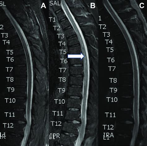 Sagittal Short Tau Inversion Recovery Stir Mri Spine At Admission