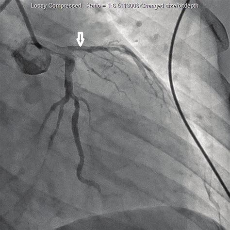 Cardiac Catheterization Which Demonstrated Blockage Of The Left