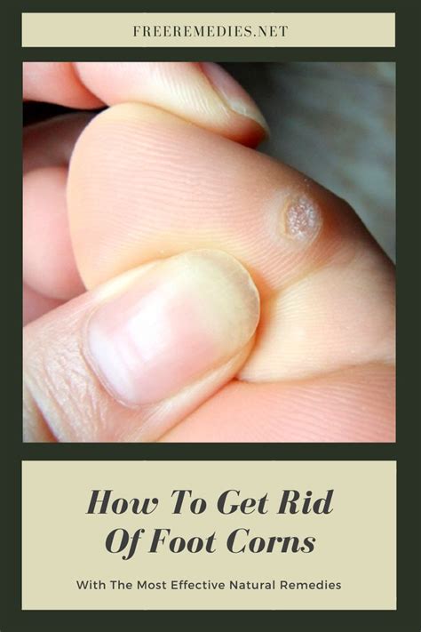 How To Get Rid Of Foot Corns With The Most Effective Natural Remedies