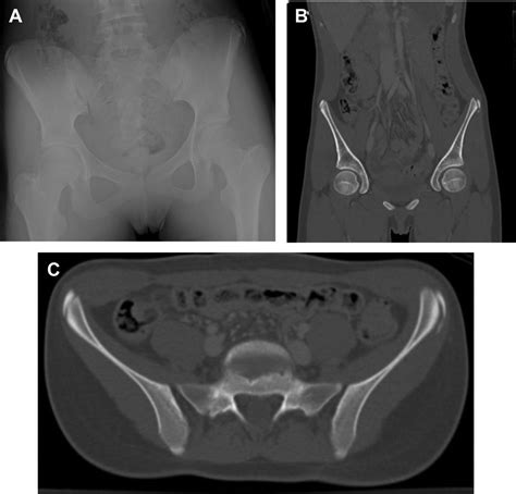 Pelvic Avulsion Injuries In The Adolescent Athlete Musculoskeletal Key