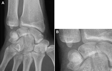 Arthroscopic Treatment Of Intraosseous Ganglion Cyst Of The Lunate Bone