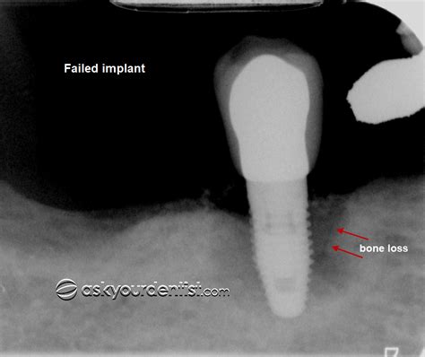 Why Do Dental Implants Fail Ask Your Dentist