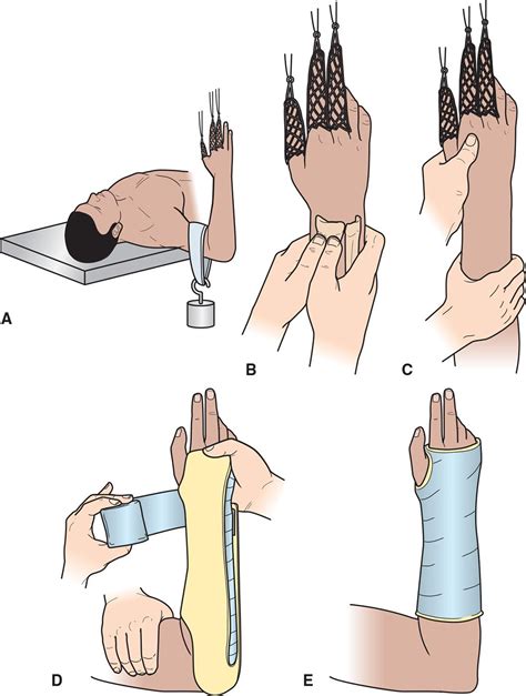 How To Do A Hematoma Block Wrist Peter Brown Bruidstaart