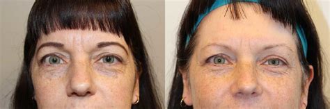 Eyelid Surgery Blepharoplasty Before And After Photos Dr Anzarut