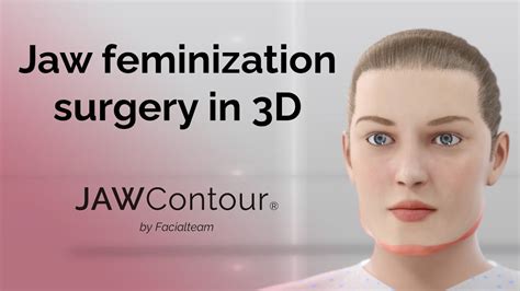 Jawcontour® 3d Precision In Jaw And Chin Feminization Surgery Youtube