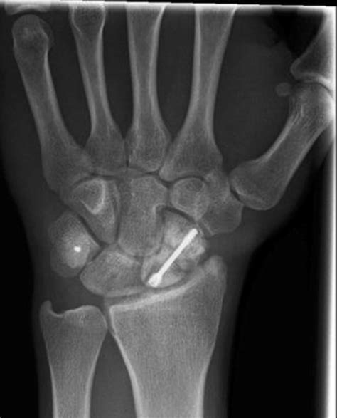 Wrist Pa X Ray At 12 Months Suggesting Non Union Of