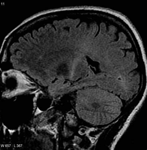 Amyotrophic Lateral Sclerosis Alchetron The Free Social Encyclopedia