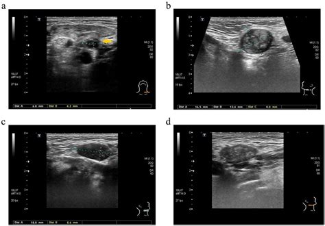 All Significant Ultrasound Features Of Malignant Lymph Nodes Lns In