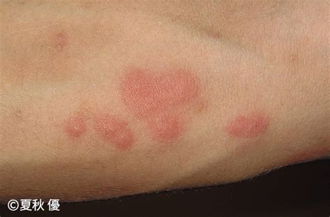 腕 に 赤い 斑点 痒く ない | ダニ刺されの症状は痒くない場合も ...