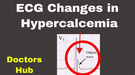 Hypercalcemia Ecg Changes Youtube