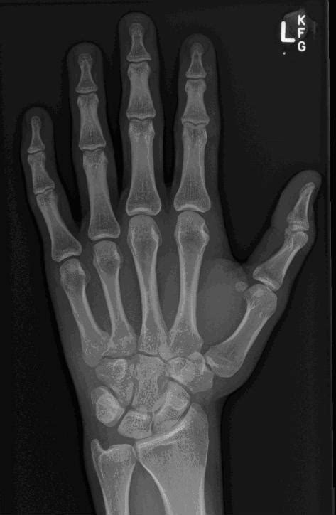 Hand Series Positioning And Radiographs Image