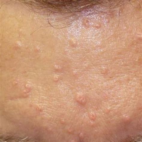 6 Skin Conditions That Look Like Acne But Isnt Acne Dr Terry Loong