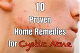 Great Home Remedies For Acne Photos