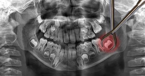 Wisdom Teeth Removal After 30 Must Know Semiahmoo Dental Centre