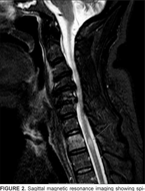 Figure 2 From Paraplegia Following Spinal Cord Contusion From An
