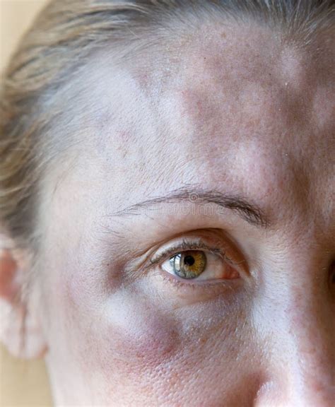 Bruises From On A Woman S Face Stock Photo Image Of Introduction