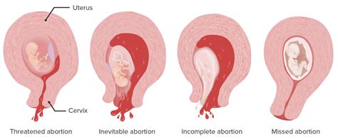 Aborto Espontáneo Concise Medical Knowledge