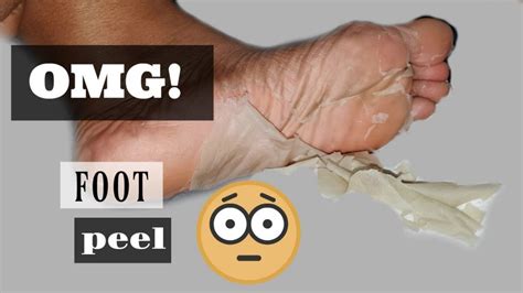 Foot Peel Foot Care Tips