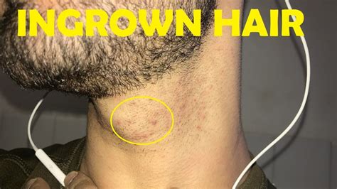 How To Get Rid Of An Ingrown Hair On The Neck Step By Step Youtube