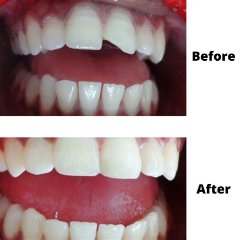 Teeth Filling Services In Cranston Ri Dental Ri