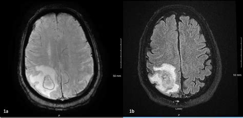 Cureus Nocardia Farcinica Brain Abscess In An Immunocompetent Host