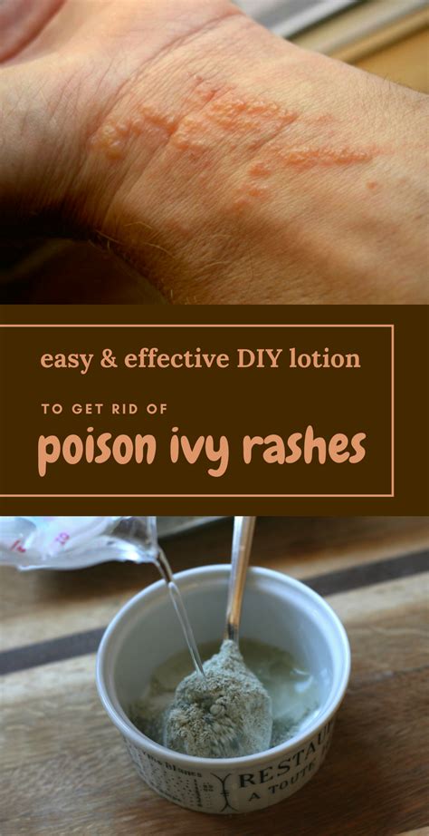 Easy And Effective Diy Lotion To Get Rid Of Poison Ivy Rashes Beauty