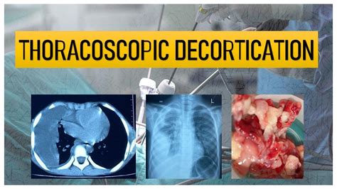 Thoracoscopic Decortication Of Lung In A Child Youtube