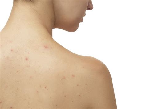 Home Remedies To Get Rid Of Back Acne