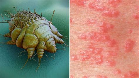 Scabies Causes Signs Treatment Options