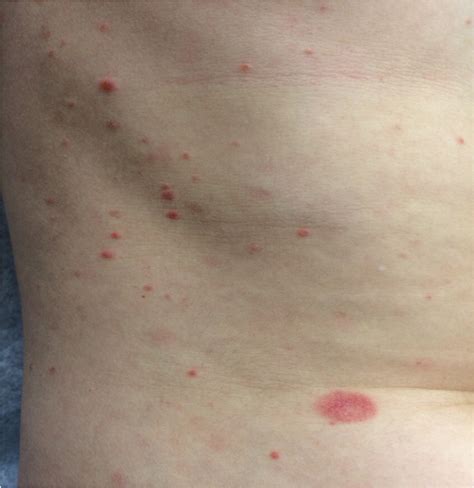 Pityriasis Rosea Diagnosis And Treatment Aafp