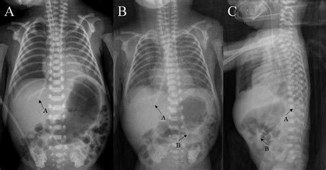 Esophageal Perforation A Complication Of Nasogastric Tube Placement In