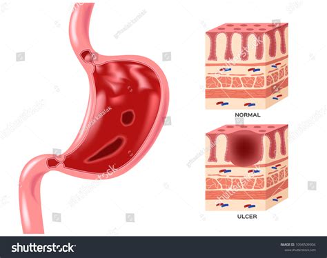 Stomach Peptic Ulcer Helicobacter Pylori Vector 스톡 벡터로열티 프리 1094509304