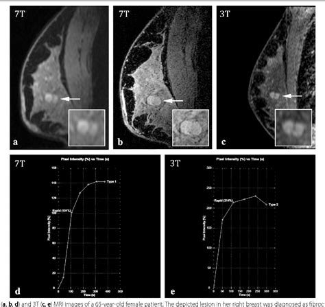 Erratum To Dynamic Contrast Enhanced Breast Mri At 7t And 3t An Intra